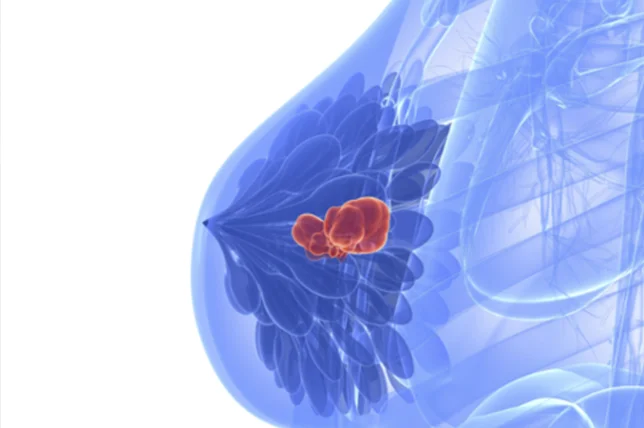 Do que realmente se trata o carcinoma ductal in situ? Artigo Dr. João Paulo, mastologista em Juazeiro do Crato